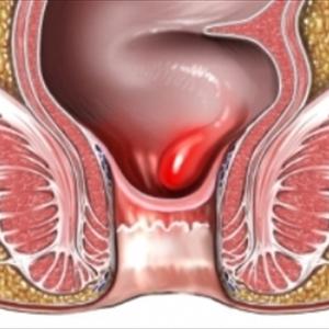 Bleeding Hemorrhoids Pregnancy 
