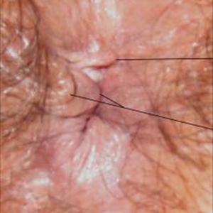 Hemorrhoids Treatment Guide - How To Get Rid Of External Hemorrhoids - External Hemorrhoid Overview