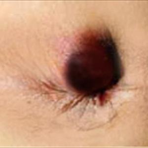  Procedure For Prolapsing Hemorrhoids
