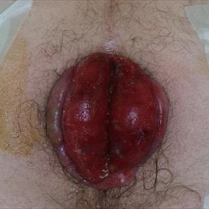 Internal Hemorrhoid - Stop Hemorrhoid Bleeding