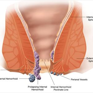 Hemroids Remedies - External Hemorrhoids: The Risk Factors And Symptoms