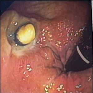 External Hemorrhoids Treated - What Are Hemorrhoid Creams Good For?