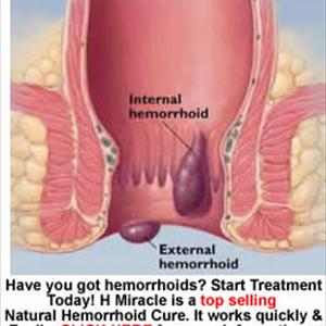 How To Cure Hemorrhoids - Prolapsed Hemorrhoids - Home Cures For Hemorrhoids - Haemorroids