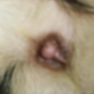 External Hemorrhoids Cream - Hemorrhoid Treatments And Steps To Take To Prevent Recurring Hemorrhoids