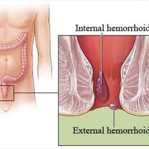 Thrombosed External Hemorrhoid Surgery 