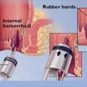  Hemorrhoids Treatment 