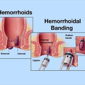  Hemoroid Remedy 