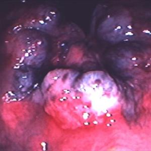  Hemorrhoids Treatment 