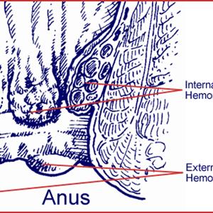 Hemorrhoid Diet - Hemorrhoids Remedies - Hem Relief - Hemroid Home Treatment