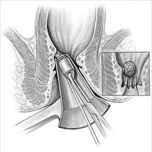 Internal Hemorrhoids Treatment Surgery - Hemorrhoidal Treatments - Hemeroid Relief - Destroy Hemorrhoids