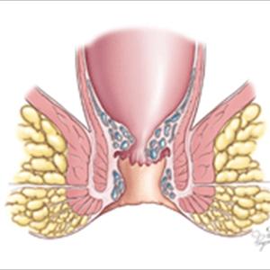 Hemorrhoid Thrombosis - Jessica Wright Hemorrhoid No More - How To Cure Hemorrhoid Review