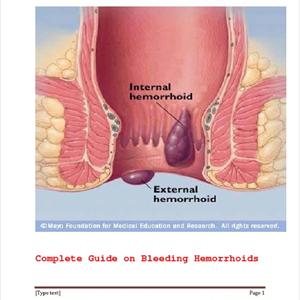 Treat A Hemorrhoid - I Need A Hemorrhoid Cure: Are There Any Good Options For A Hemorrhoid Cure?