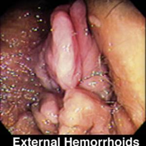External Thrombosed Hemorrhoid - Hemorrhoid Treatment For The Four Stages Of Internal Hemorrhoids