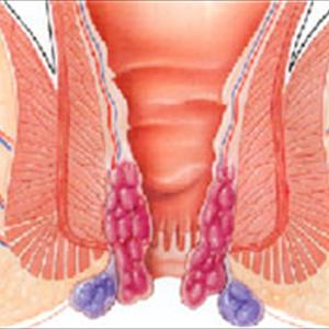 Hemorrhoids 