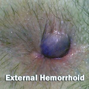 Hemorrhoid Suppositories - 4 Useful Advices For Natural Hemorrhoid Treatment