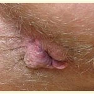 External Thrombus Hemorrhoid - Hemorrhoids Treatments At Home