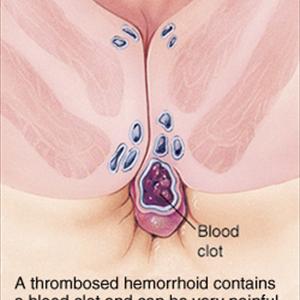Natural Treatment For Hemroids - When Is Hemorrhoid Surgery Needed?